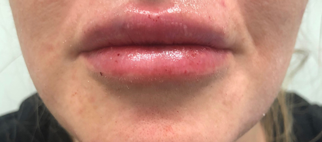 Juvederm Ultra Before & After Image