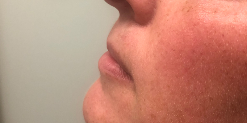 Juvederm Volbella Before & After Image