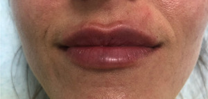 Juvederm Volbella Before & After Image