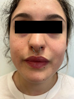 Lip Filler Before & After Image