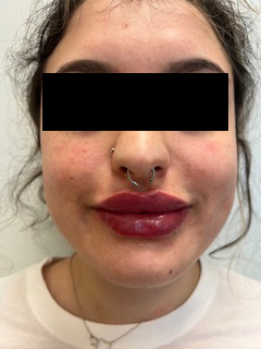 Lip Filler Before & After Image