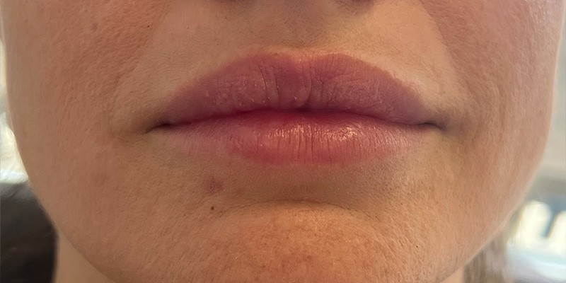 Lip Filler Before & After Image