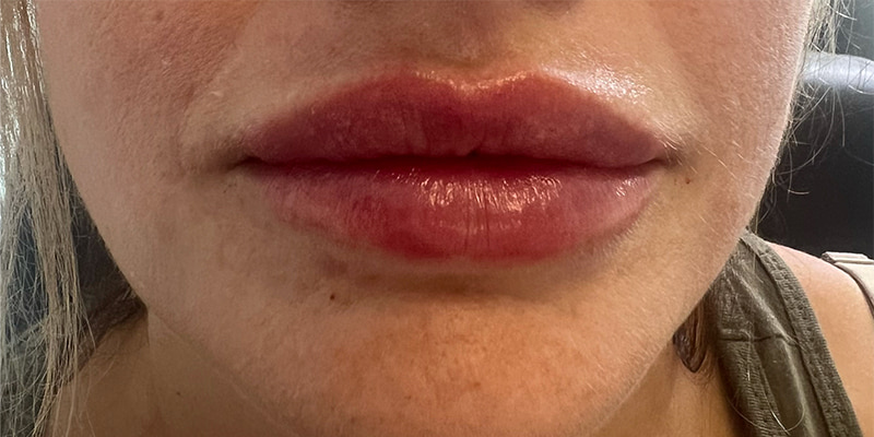 Lip Filler Before & After Image