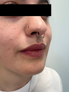 Lip Filler Before & After Image