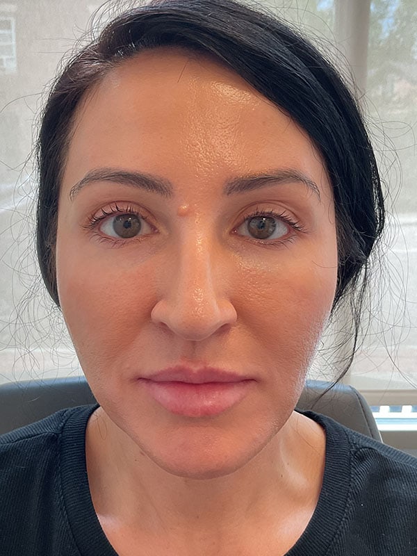 Lip Filler Before & After Image