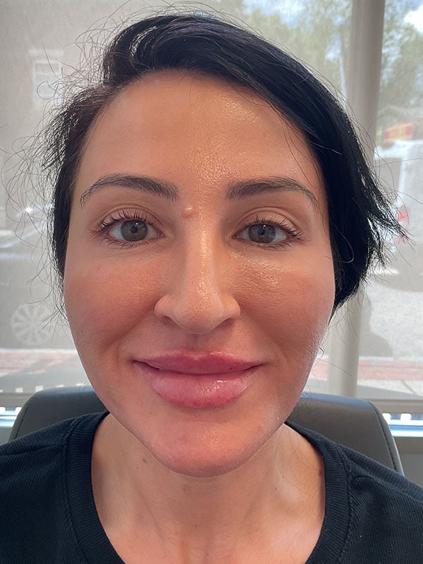 Lip Filler Before & After Image