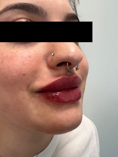 Lip Filler Before & After Image