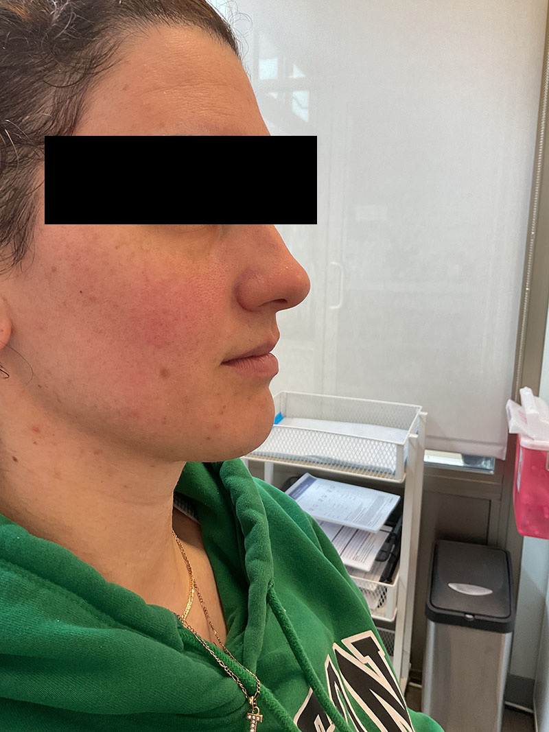 Lip Filler Before & After Image
