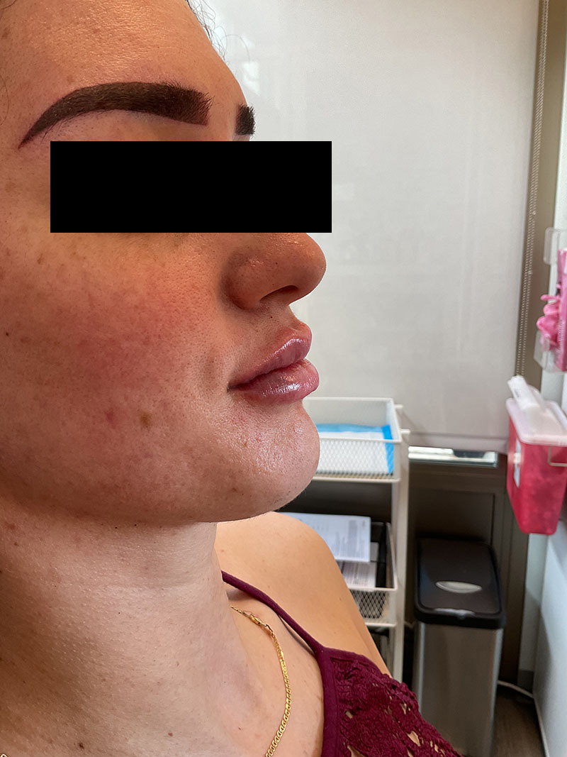 Lip Filler Before & After Image