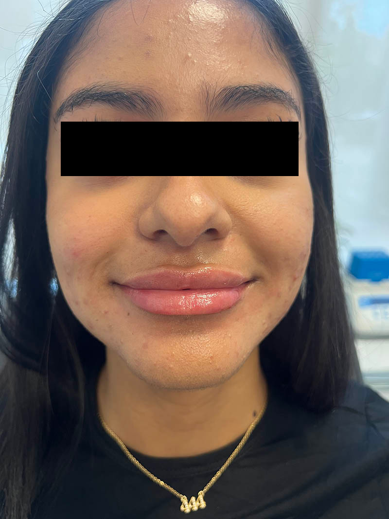 Lip injection before after photos Before & After Image