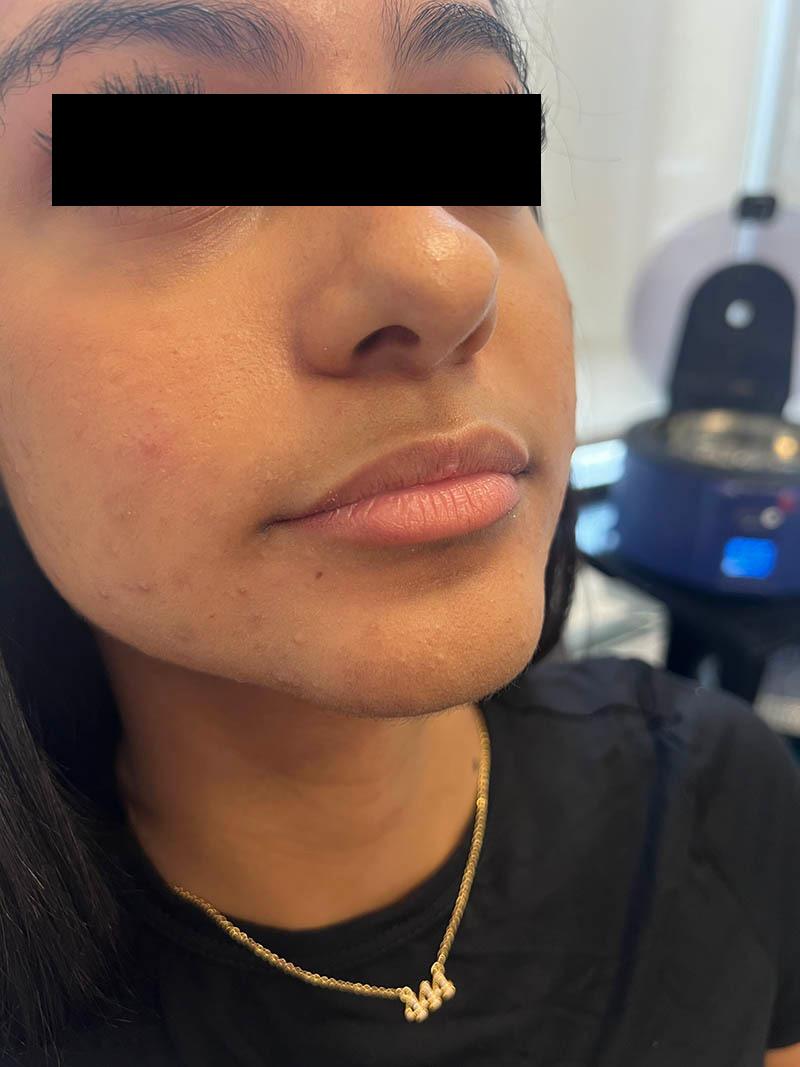 Lip injection before after photos Before & After Image