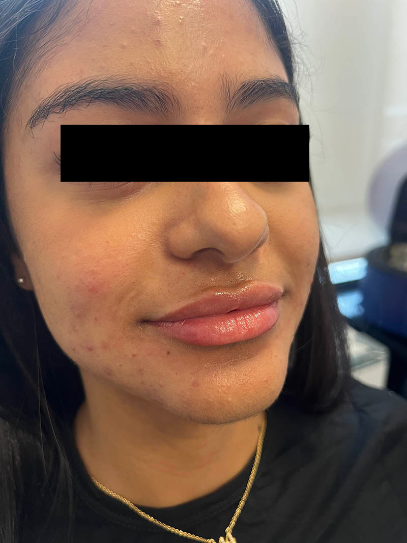 Lip injection before after photos Before & After Image