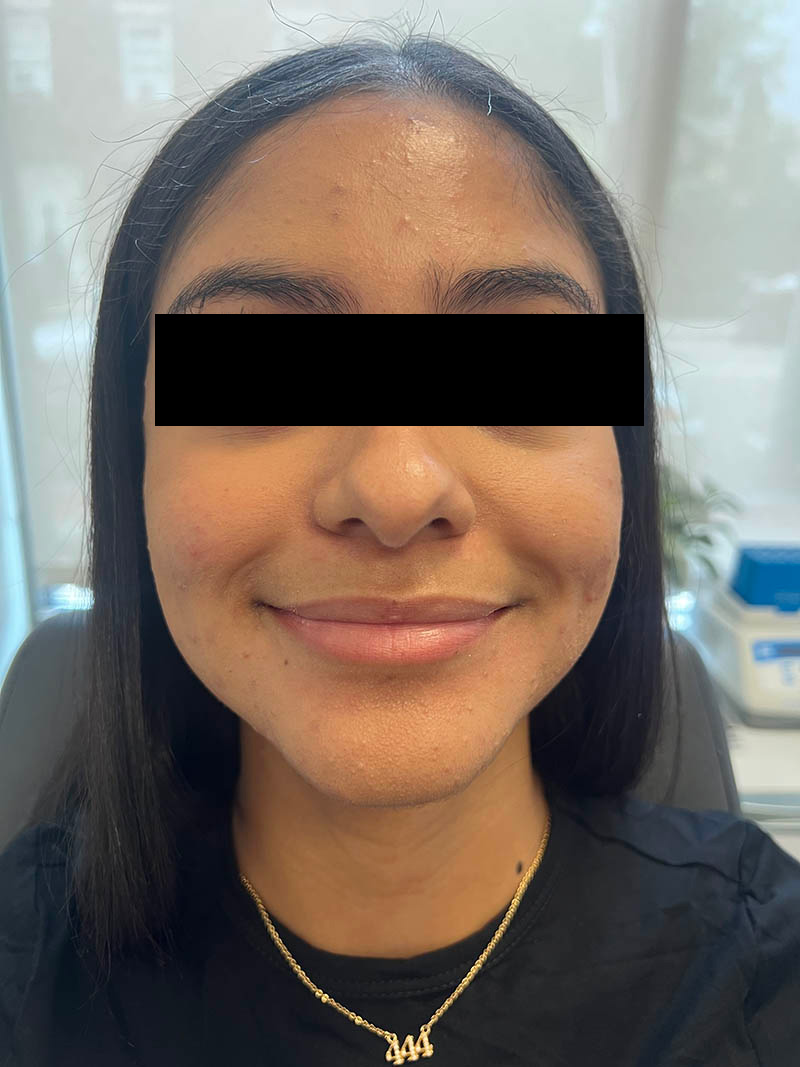 Lip injection before after photos Before & After Image