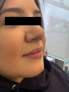 Restylane Kysse Before & After Image