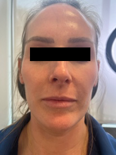 Restylane Kysse Before & After Image