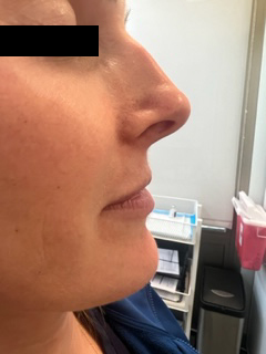 Restylane Kysse Before & After Image