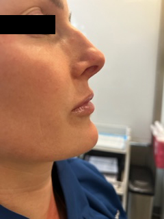 Restylane Kysse Before & After Image