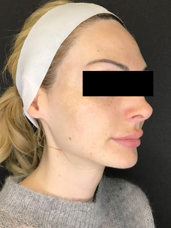 Sciton BBL Before & After Image