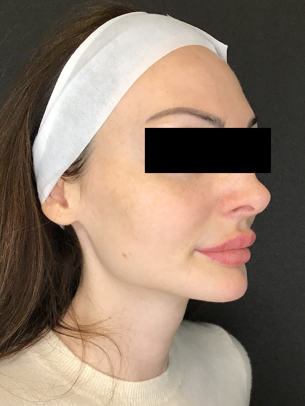 Sciton BBL Before & After Image