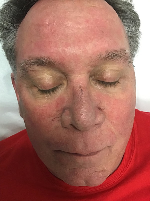 Spider Vein Treatment Before & After Image