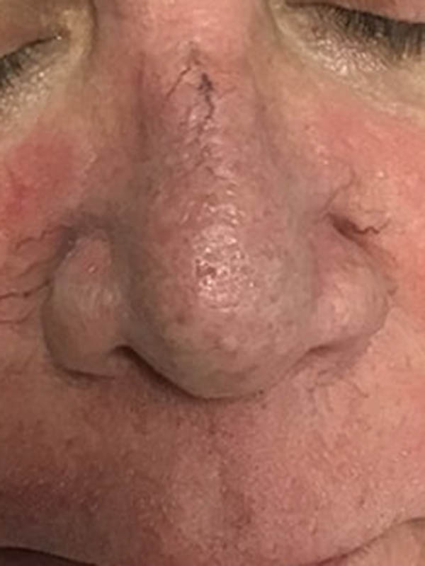 Spider Vein Treatment Before & After Image