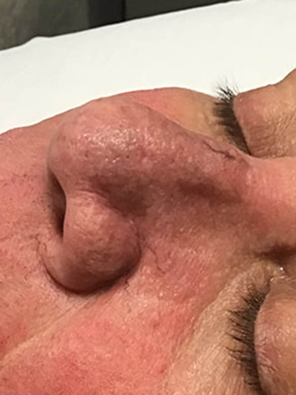 Spider Vein Treatment Before & After Image