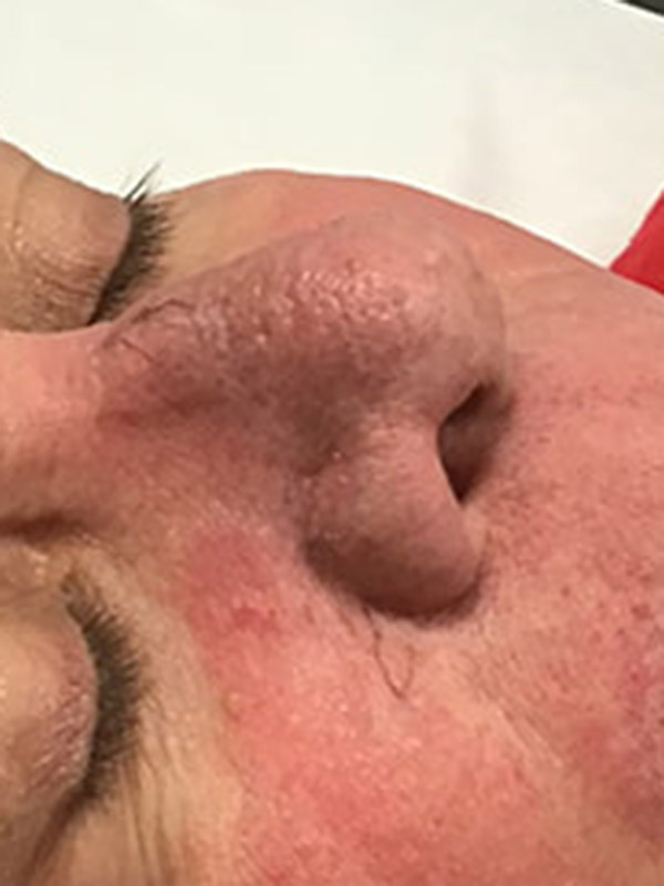 Spider Vein Treatment Before & After Image