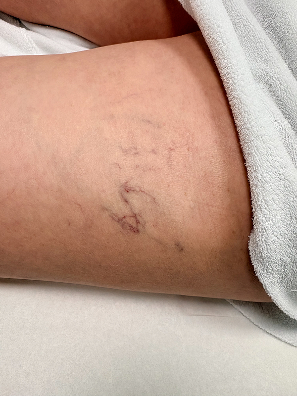 Spider Vein Treatment Before & After Image
