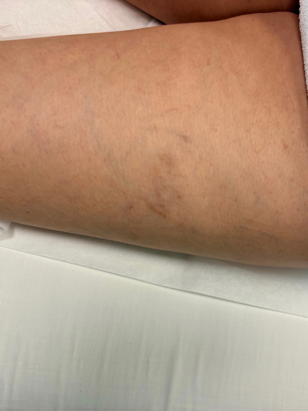 Spider Vein Treatment Before & After Image