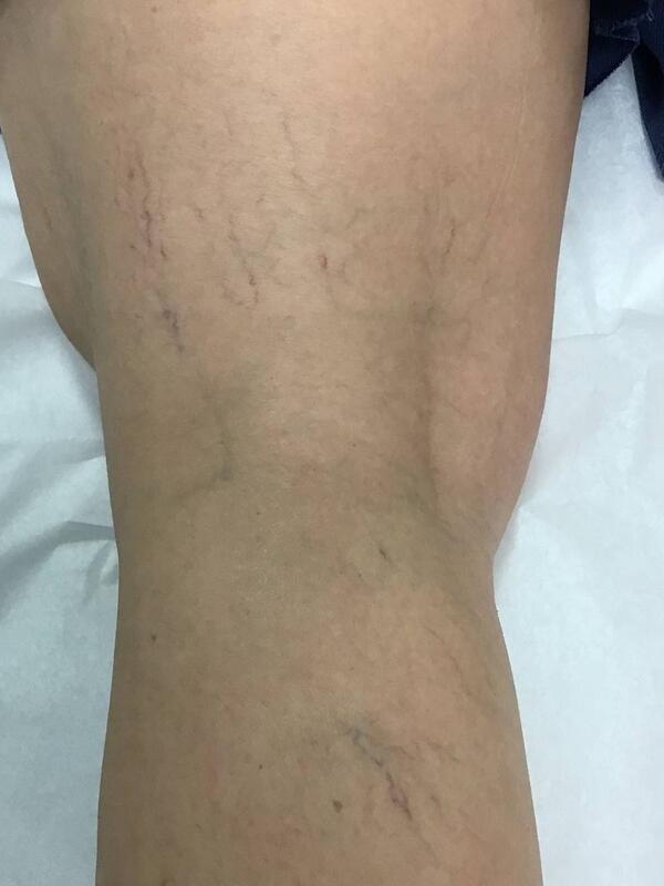 Spider Vein Treatment Before & After Image