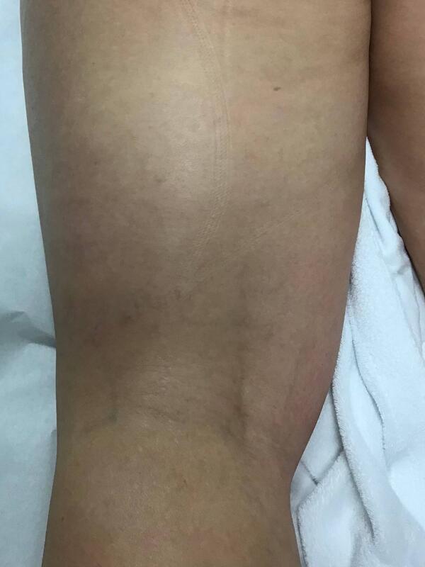 Spider Vein Treatment Before & After Image