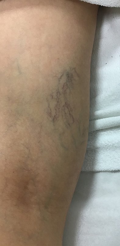 Spider Vein Treatment Before & After Image