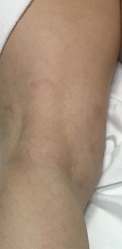 Spider Vein Treatment Before & After Image