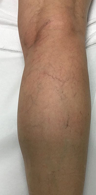 Spider Vein Treatment Before & After Image