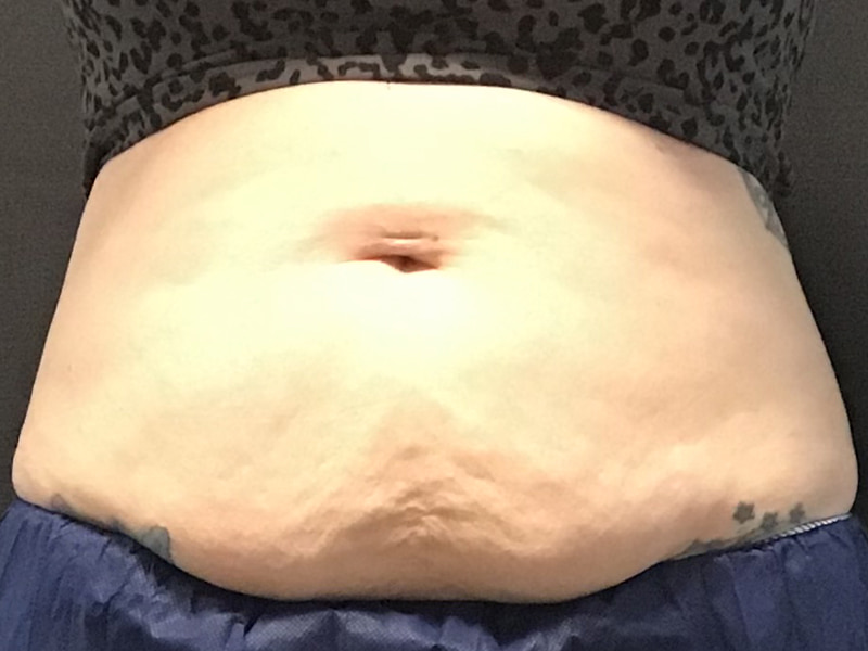 CoolSculpting Before & After Image