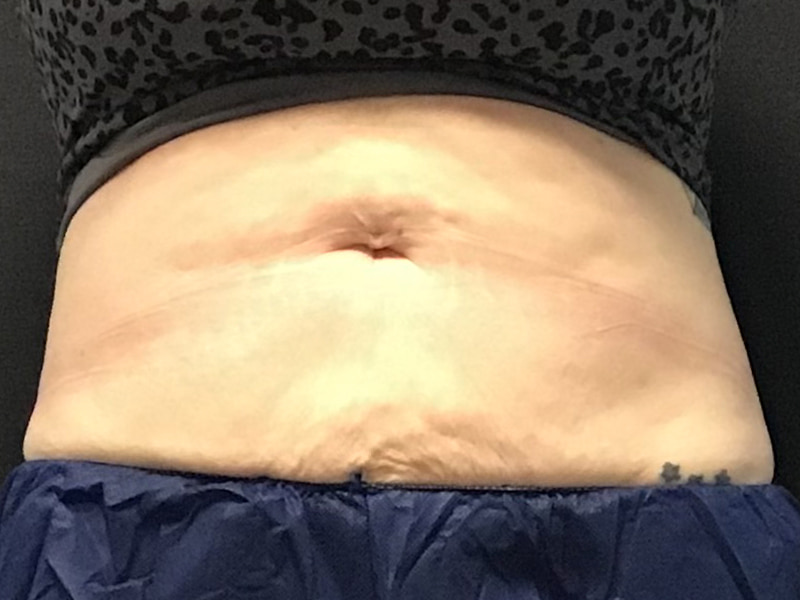 CoolSculpting Before & After Image