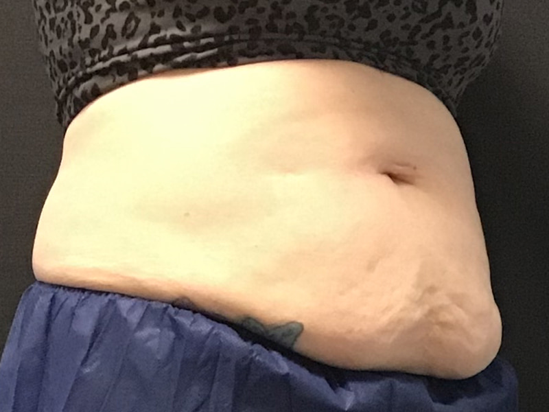 CoolSculpting Before & After Image