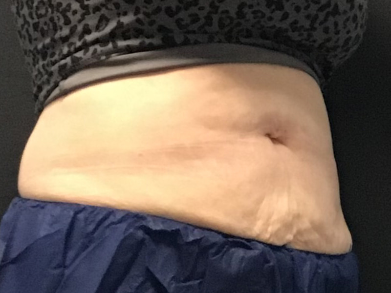 CoolSculpting Before & After Image