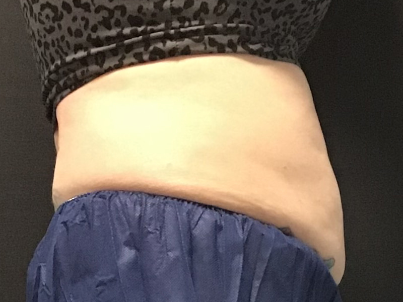 CoolSculpting Before & After Image