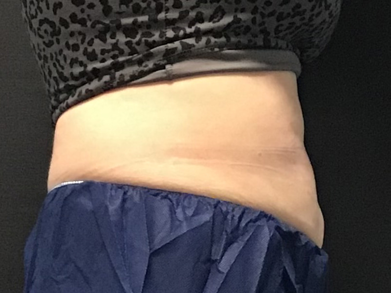 CoolSculpting Before & After Image