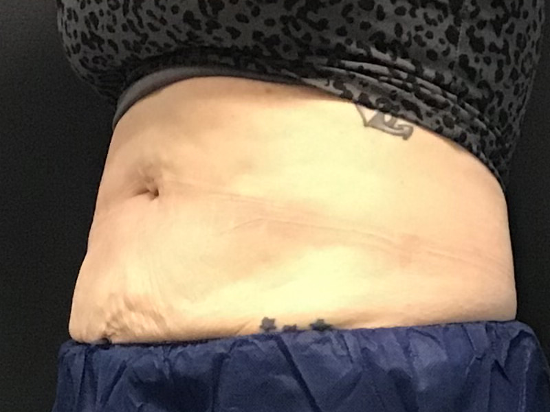 CoolSculpting Before & After Image