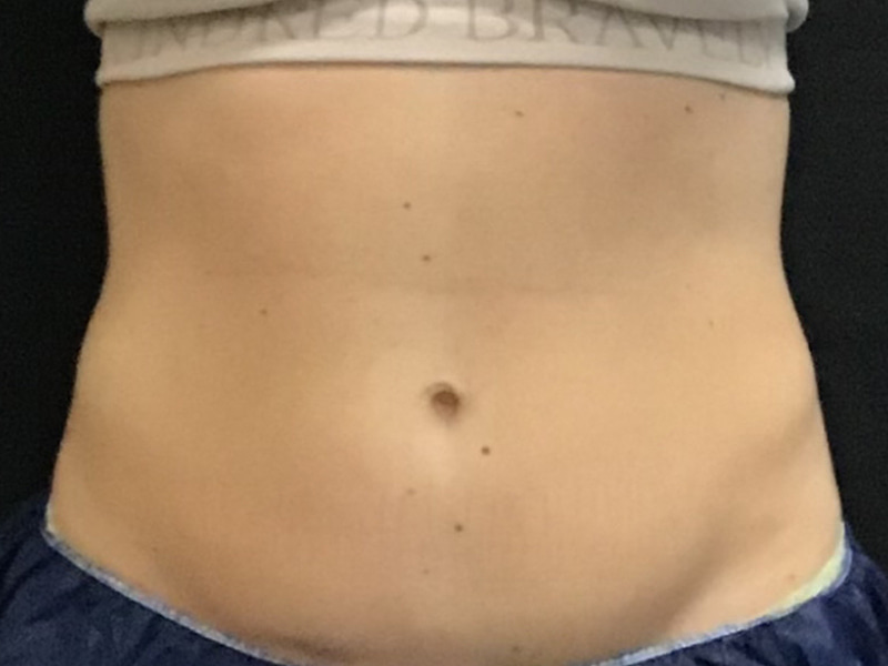 CoolSculpting Before & After Image