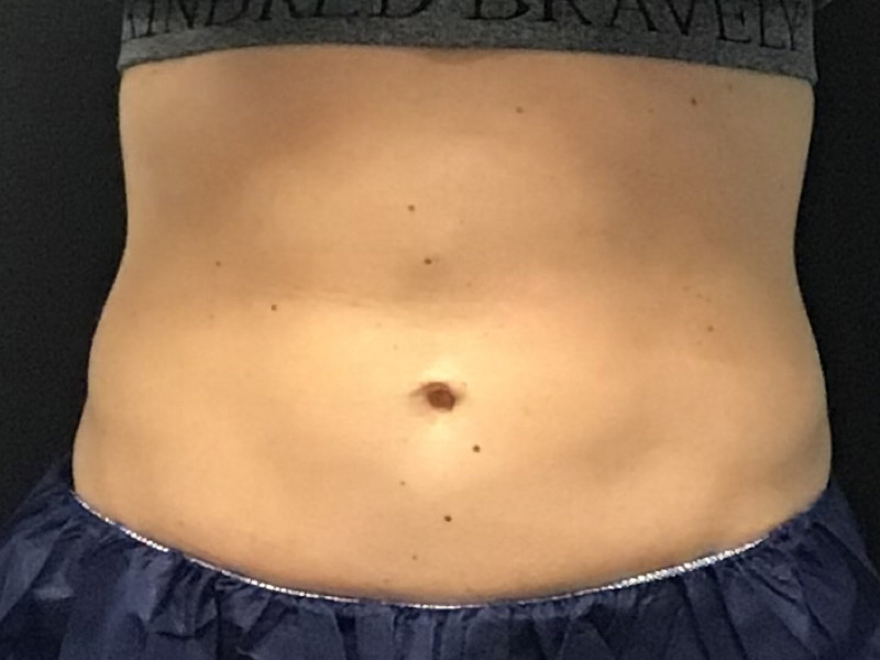 CoolSculpting Before & After Image