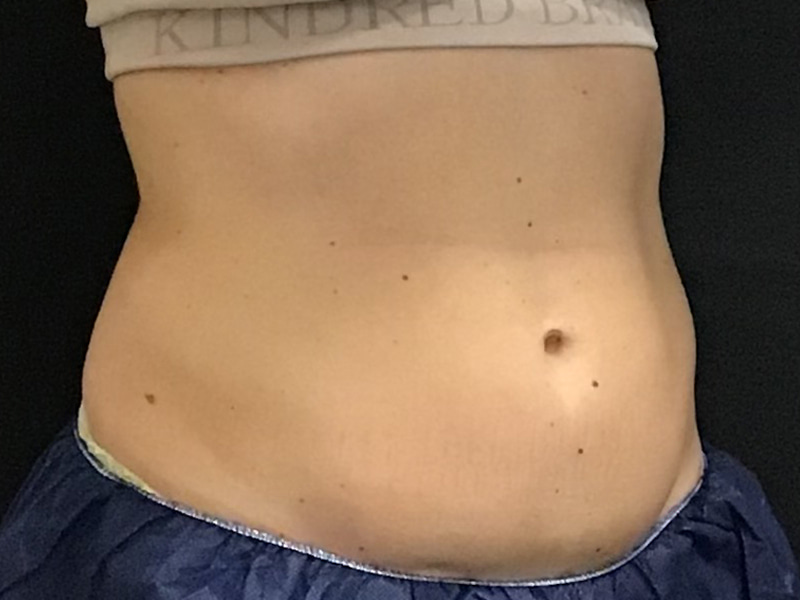 CoolSculpting Before & After Image