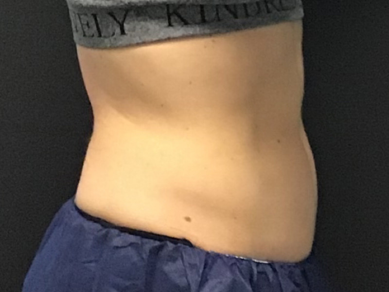 CoolSculpting Before & After Image