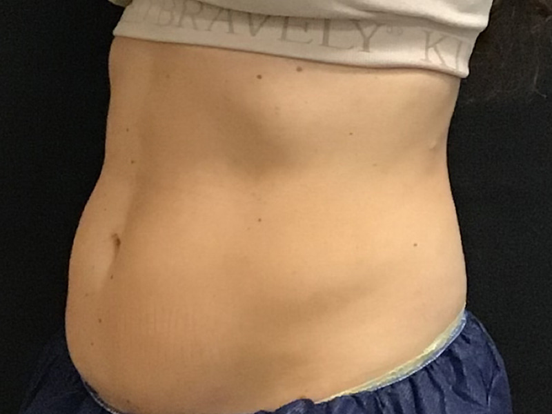 CoolSculpting Before & After Image