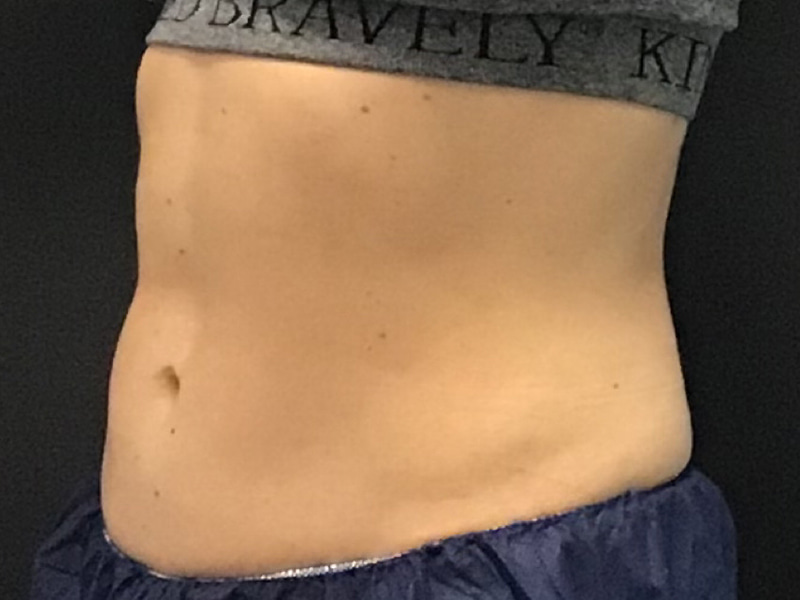 CoolSculpting Before & After Image