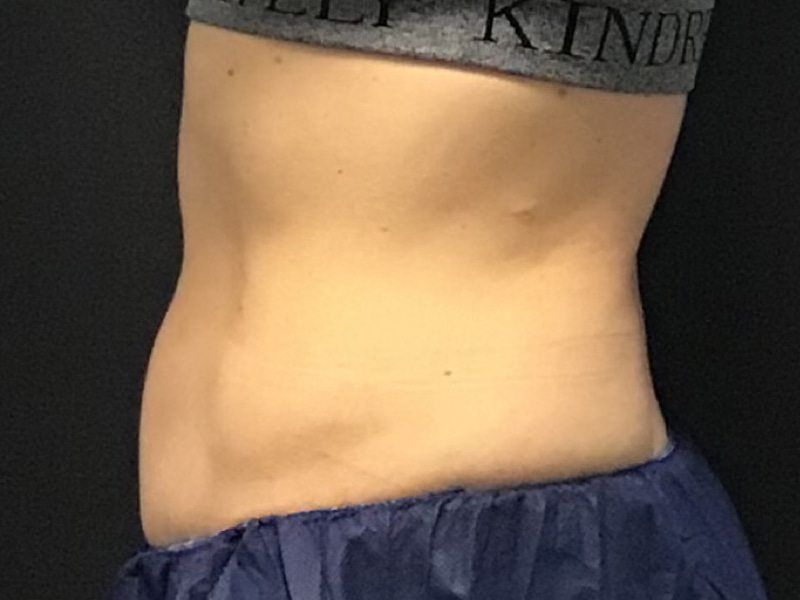 CoolSculpting Before & After Image