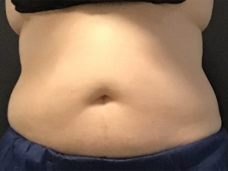 CoolSculpting Before & After Image