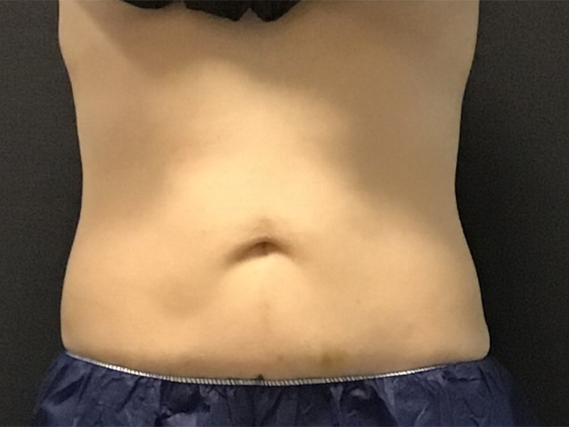 CoolSculpting Before & After Image